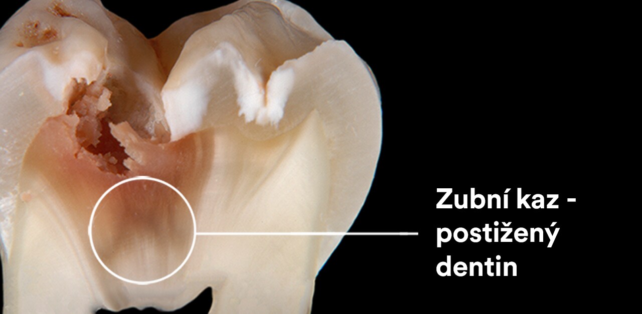Průřez zubem s dentinem postiženým zubním kazem
